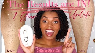 The Results are IN At home laser hair removal 1 Yr Update feat RoseSkinCo Lumi  IPL Journey [upl. by Walrath]