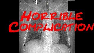 Horrible complication after cardiac intervention Cardiology Forum Echocardiography QuizCase [upl. by Frechette611]