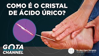 COMO É O CRISTAL DE ÁCIDO ÚRICO [upl. by Elodea]