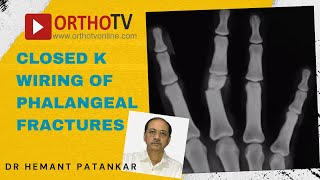 Closed K Wiring of Phalangeal Fractures  Dr Hemant Patankar [upl. by Ahsienaj47]