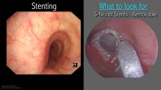 Mastering Bronchoscopy for Thoracic Surgery Chapter 3 [upl. by Nodyroc558]