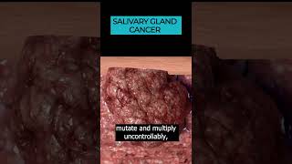 Salivary Gland Cancer Uncovering Head and Neck Cancer Types 🎗️🩺 [upl. by Amrak]