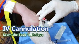 IV Cannulation  Learn the Basic Technique  IV Cannula [upl. by Cohn993]