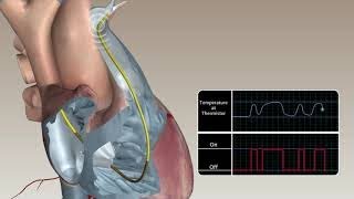 Swan Ganz continuous cardiac output animation [upl. by Matthei]