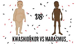 SAM  Severe Acute Malnutrition  Kwashiorkor VS Marasmus [upl. by Gathard248]