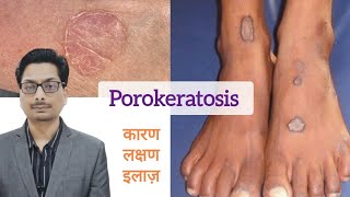 Porokeratosis का कारण लक्षण और इलाज़  Porokeratosis और cancer porokeratosis skincancer cancer [upl. by Zetra78]