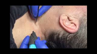 Skin tag removal on neck skintag [upl. by Harriot252]