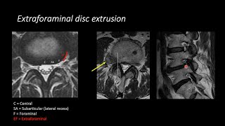 Lumbar Spine MRI by Eric Tranvinh MD Stanford Radiology [upl. by Hoxsie482]