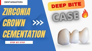 Master Zirconia Crown Cementation StepbyStep Guide for Dentists [upl. by Aicilyt]