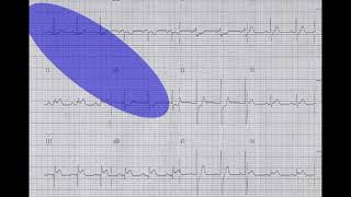 Emergency Medicine CME amp Pearls of EKG Interpretation ECG Interpretation [upl. by Neih]