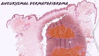 Aneurysmal dermatofibroma dermatofibroma with internal hemorrhage pathology dermpath dermatology [upl. by Cardie]