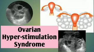 Case report Ovarian Hyperstimulation Syndrome OHSS🤰🤰USG imagingRadiology 20 [upl. by Adlecirg]