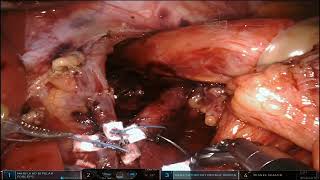 Robotic Cruroplasty Hiatoplasty and Nissen Fundoplication for GERD and type1 Hiatal Hernia [upl. by Fevre858]