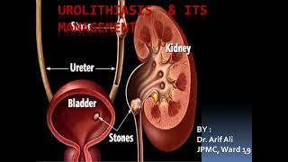 Urolithiasis Surgery Lecture  Kidney Stones signs symptoms risk factor pathophysiology treatment [upl. by Eben]