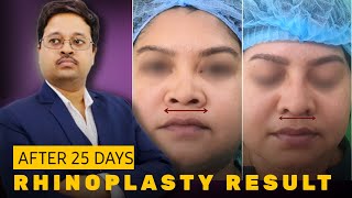 Rhinoplasty Results After 25 days  Nose job  Kolkata  Dr Jayanta Bain plastic surgeon [upl. by Hild137]