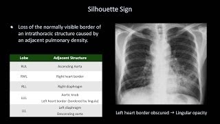 How to Interpret a Chest XRay Lesson 8  Focal Lung Processes [upl. by Torry]