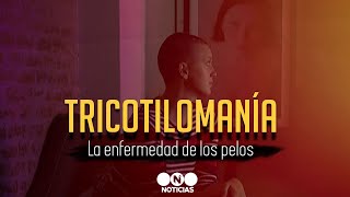 TRICOTILOMANÍA LA ENFERMEDAD DE LOS PELOS  Telefe Noticias [upl. by Rebm654]