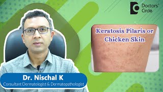 How to get rid of KERATOSIS PILARIS or CHICKEN SKIN expertskisuno Dr Nischal K Doctors Circle [upl. by Scribner]