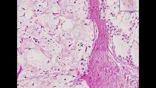 Histopathology Soft tissue retroperitoneum Liposarcoma [upl. by Airym]