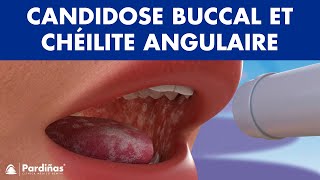 CANDIDOSE buccal muguet et chéilite angulaire  Champignon dans la bouche © [upl. by Lelia]