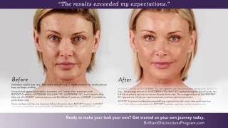 Botox Juvederm amp Voluma Before and After Photos [upl. by Kisung]