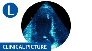 Takotsubo cardiomyopathy in a patient with Lynch syndrome [upl. by Leihcim]