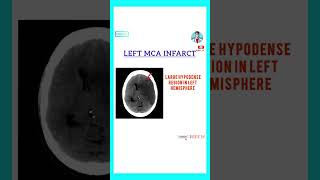 Top 10 Must Know CT Head Findings  Quick Radiology Guide radiology neuroscience neet [upl. by Reaht]