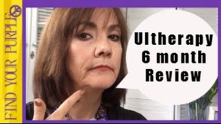 Ultherapy 6 month Review [upl. by Sajet]