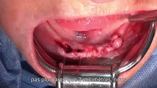 implants symphysaires extraction implantation immédiate [upl. by Cheyne232]