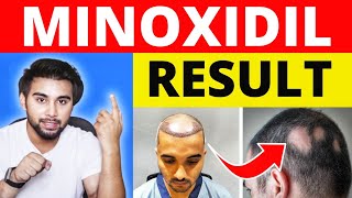 Dark Side Of Using Minoxidil After Hair Transplant  Effects Of Minoxidil On Hair Transplant Result [upl. by Rusert602]