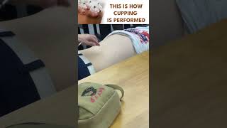 How Cupping is performed [upl. by Naujtna]