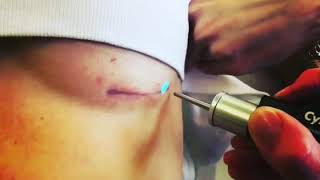 Pulsed Dye Laser Treatment PDL [upl. by Deland]