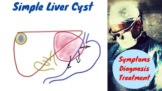 Simple Liver Cyst  Symptoms Diagnosis and Treatment [upl. by Atiral704]