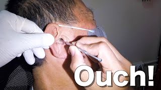 Very Hard Earwax Removed From Elderly Mans Ear  Its Stuck [upl. by Sink]