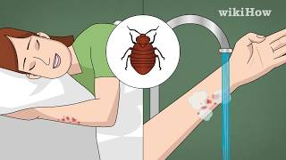 How to Treat Bed Bug Bites [upl. by Demah]