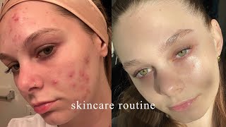 the skincare routine that FINALLY cleared my acne [upl. by Dana]