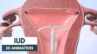 How does an IUD work  3D animation [upl. by Yelruc]