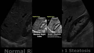 Fatty Liver Grading On Ultrasound  Hepatic Steatosis Grades 123  Normal Vs Abnormal USG shorts [upl. by Hameean]