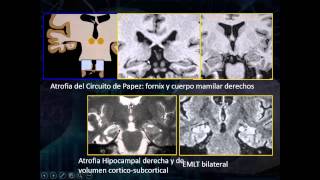 Resonancia Magnetica Epilepsia crisis convulsivas evaluacion de esclerosis mesial temporal [upl. by Nirro]