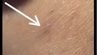 Electrolysis on Ingrown Hairs Step by Step [upl. by Razal]