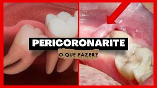 Pericoronarite O que é [upl. by Ayifa]