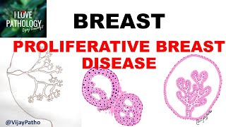 DISEASES OF BREAST Part 2 PROLIFERATIVE BREAST DISEASE [upl. by Annayek]