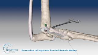 Ricostruzione del Legamento Tarsale Collaterale Mediale con NOVALIG [upl. by Jocelyne]