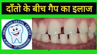 Gap between teeth Composit diastema closure at himalayan Dental Almora [upl. by Ariew]