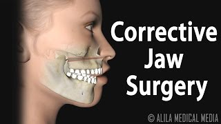 Corrective Jaw Orthognathic Surgery Animation [upl. by Grimaldi]