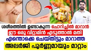 അലര്ജി എന്തൊക്കെ ചെയ്തിട്ടും മാറുന്നില്ലേ  ഈ ഒരു വിറ്റാമിന് എടുത്താൽ അലര്ജി പൂർണമായി മാറും ALLERGY [upl. by Allred]