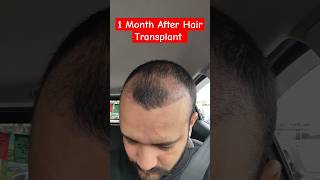 1 Month After Hair Transplant haitransplant besthairtransplant hairdhihairtransplantation [upl. by Dillie]