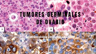 Tumores Malignos de Células Germinales de Ovario [upl. by Eliza]