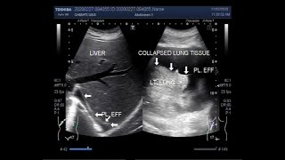 Ultrasound Video showing Pleural effusion with collapsed lung tissue [upl. by Jemima985]