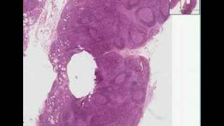 Histopathology Lymph nodeToxoplasmosis [upl. by Pelage]